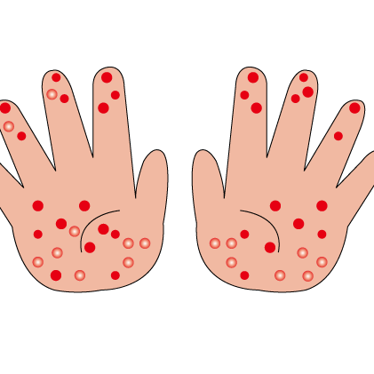 掌蹠膿疱症